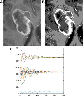 Morphological and Fractal Properties of Brain Tumors